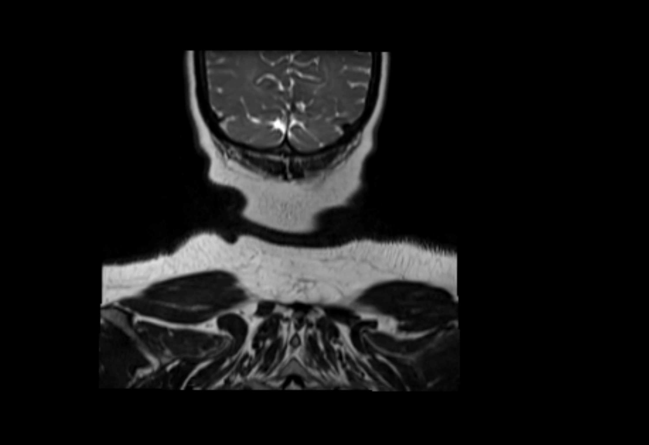 Neck coronal lymph node cross sectional MRI anatomy 3T MRI  image-img-00001-00001.webp
